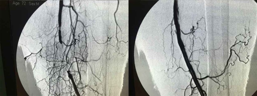 arti-inferiori---arterie-2